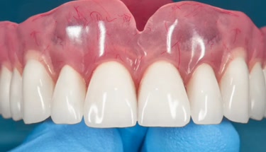 Invisible Dentures Explained: Understanding Your Options for a Seamless Smile