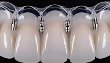 Long Term Care Tips for Screwless Implant Crowns
