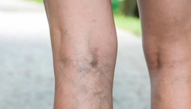 Como os idosos podem economizar nos custos de tratamento de varizes através do sistema público de saúde?