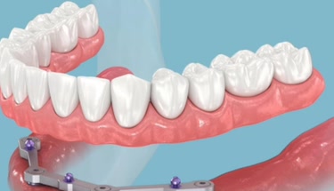 Moderne Implantattechnologie ohne sichtbare Komponenten