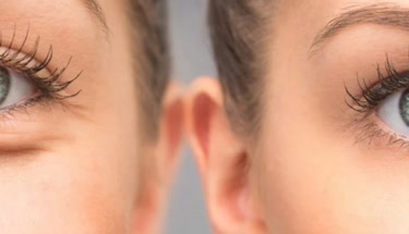 A Complete Guide to Understanding and Lifting Drooping Eyelids