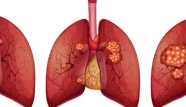 Understanding the Stages and Progression of Non-Small Cell Lung Cancer