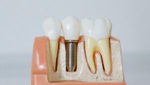 Dental Insurance for Seniors: Your Guide to Affordable Coverage