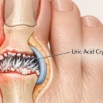 Guide to Gout: Clear Facts on Causes and Triggers