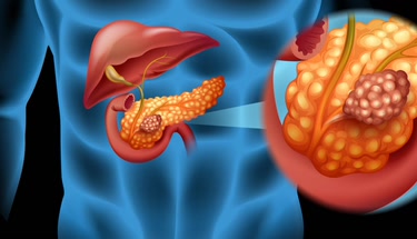 Understanding Pancreatic Cancer: Key Facts and What to Avoid