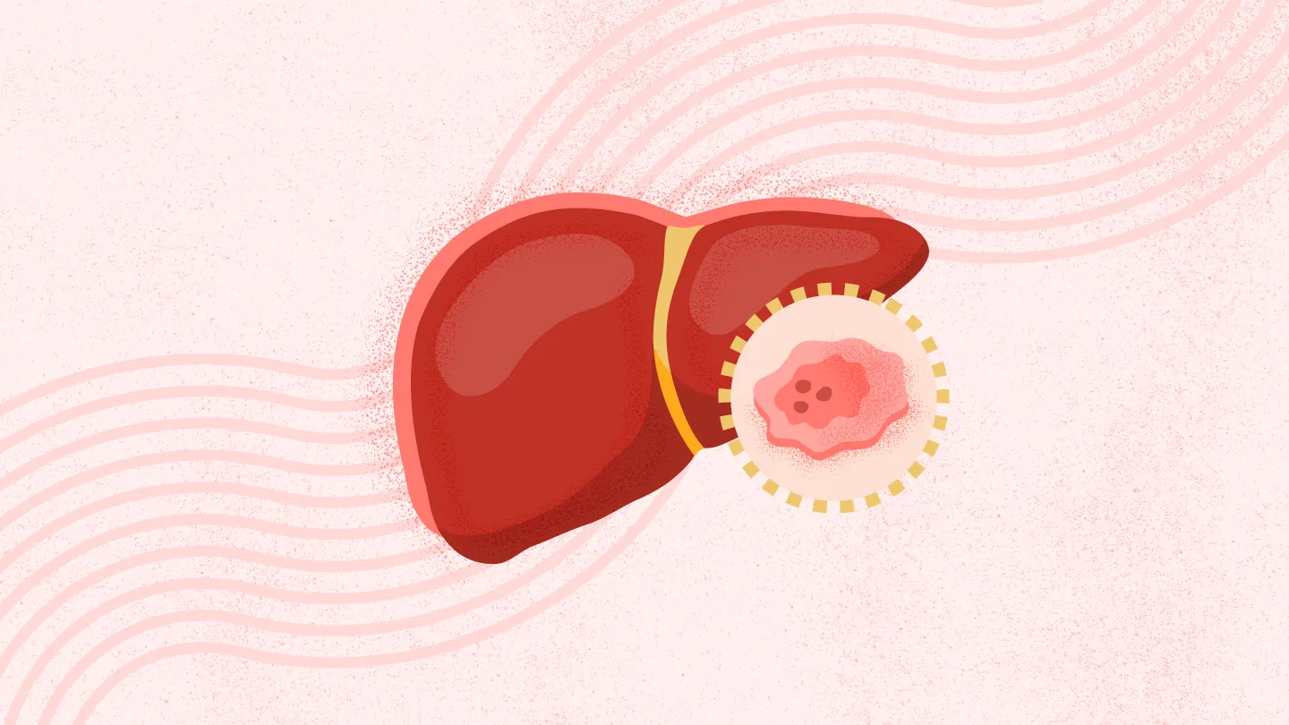 Strategies To Reduce Your Risk Of Liver Cancer